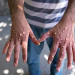 Kanada'da Maymun Çiçeği Alt Tür 1 Vakası