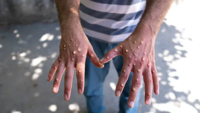 Kanada'da Maymun Çiçeği Alt Tür 1 Vakası