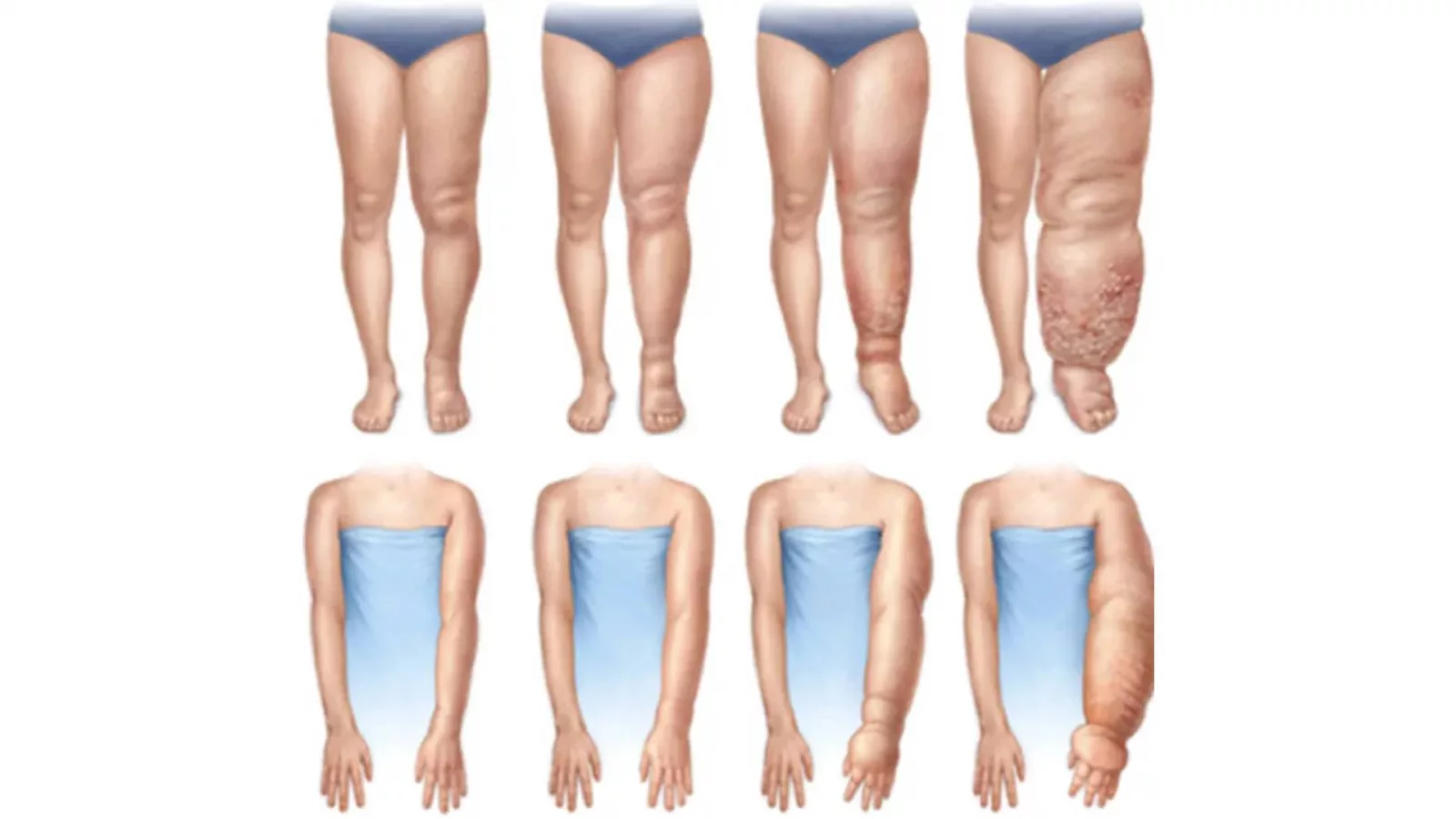 Lenfödem: Gizli Salgın Hakkında Bilinmesi Gerekenler